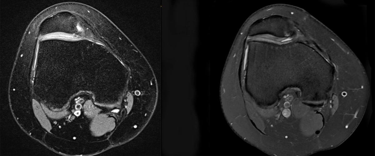 Scanningsbillede af et knæ.