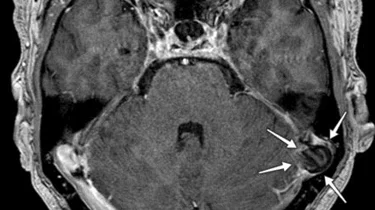 Røntgenbillede af knæ.
