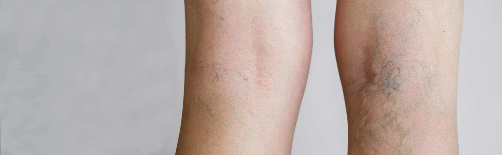 En kvinde viser sine åreknuder på benet.