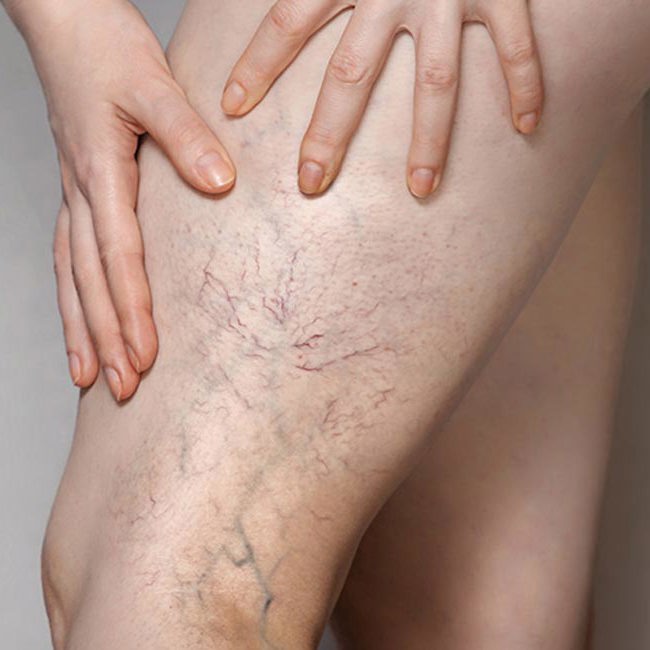 En kvinde viser sine åreknuder på benet.