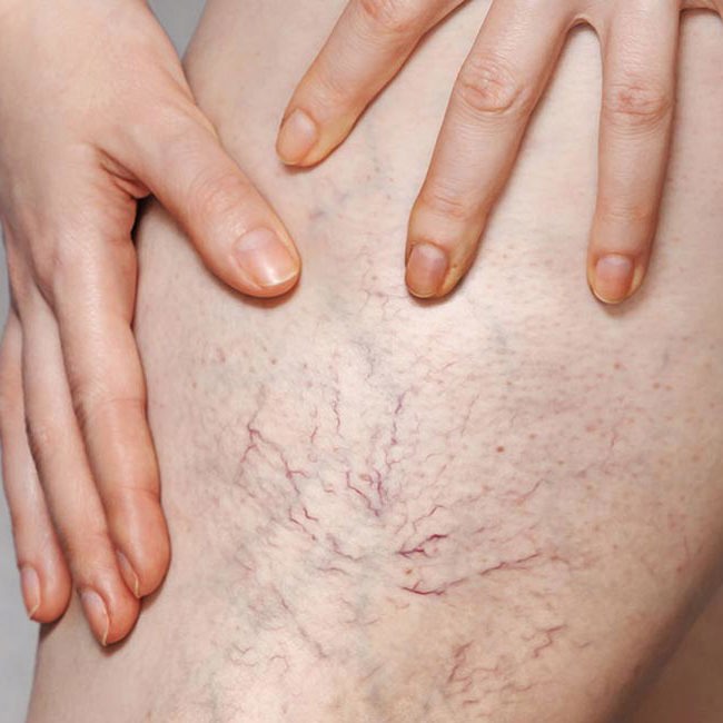 En kvinde viser sine åreknuder på benet.