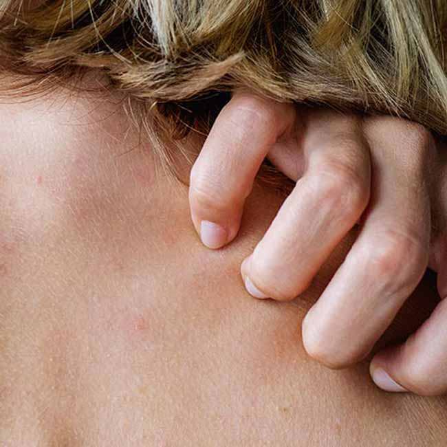 Kvinde med allergi udbrud klør sig på ryggen.