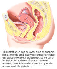 Svær grad af endometriose.