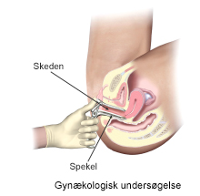 Gynækologisk undersøgelse.