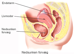 Nedsuy