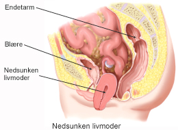 Nedsunken livmoder.