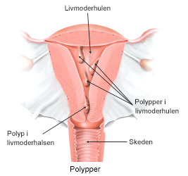 Polypper i livmoderhulen.