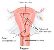 Polypper i livmoderhulen.