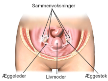 Sammenvoksninger af æggeleder og æggestok.