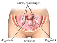Sammenvoksninger af æggeleder og æggestok.