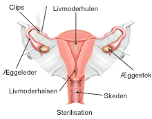 Sterilisation af livmoderen.