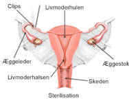 Sterilisation af livmoderen.
