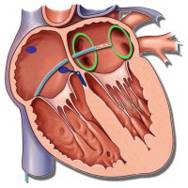 Illustration af RFA ablation.