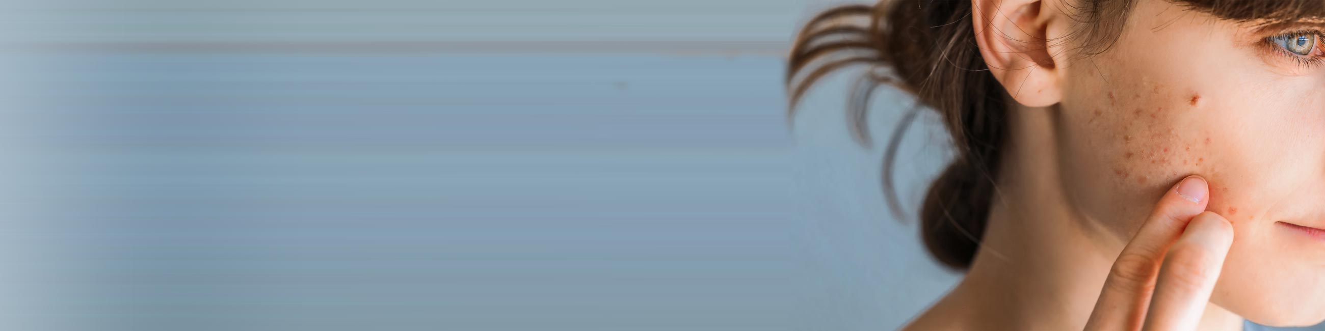 En kvinde lider af akne i ansigtet.