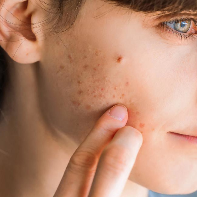 En kvinde lider af akne i ansigtet.