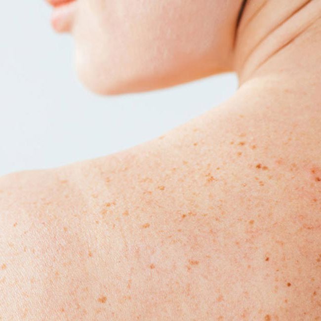 En kvinde, som skal til at få taget en allergitest.