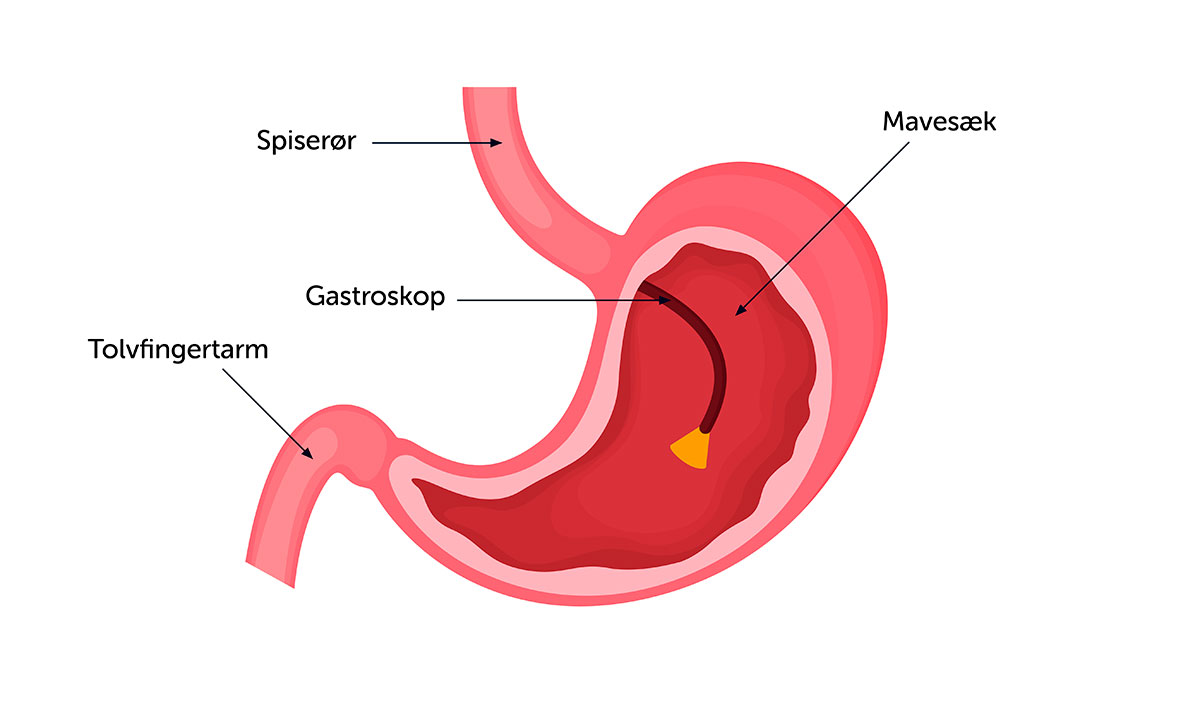 Illustration af gastroskopi.