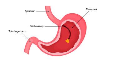 Illustration af gastroskopi.