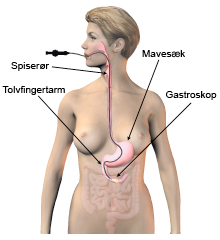 Illustration af gastroskopi.