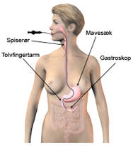 Illustration af gastroskopi.
