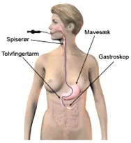 Illustration af gastroskopi.