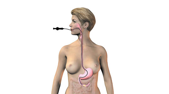 Illustration af gastroskopi.