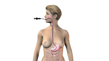 Illustration af gastroskopi.