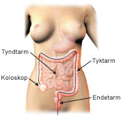 Illustration af koloskopi.