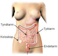 Illustration af koloskopi.