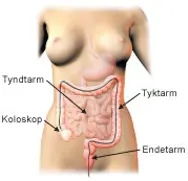 Illustration af koloskopi.