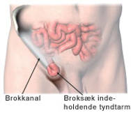 Brokkanal og broksæd indeholdende tyndtarm.