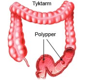 Polypper i tyktarmen.