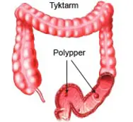 Polypper i tyktarmen.