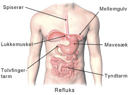 Refluks.