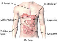 Refluks.