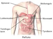 Refluks.
