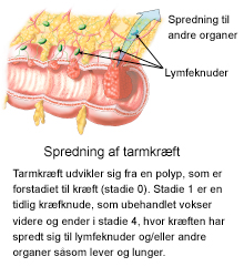 Figur, der viser og forklarer spredning af tarmkræft.