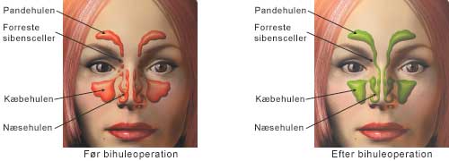 Før bihuleoperation og efter bihuleoperation.