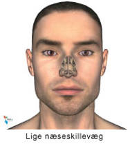 Illustration af en skæv næseskillevæg.