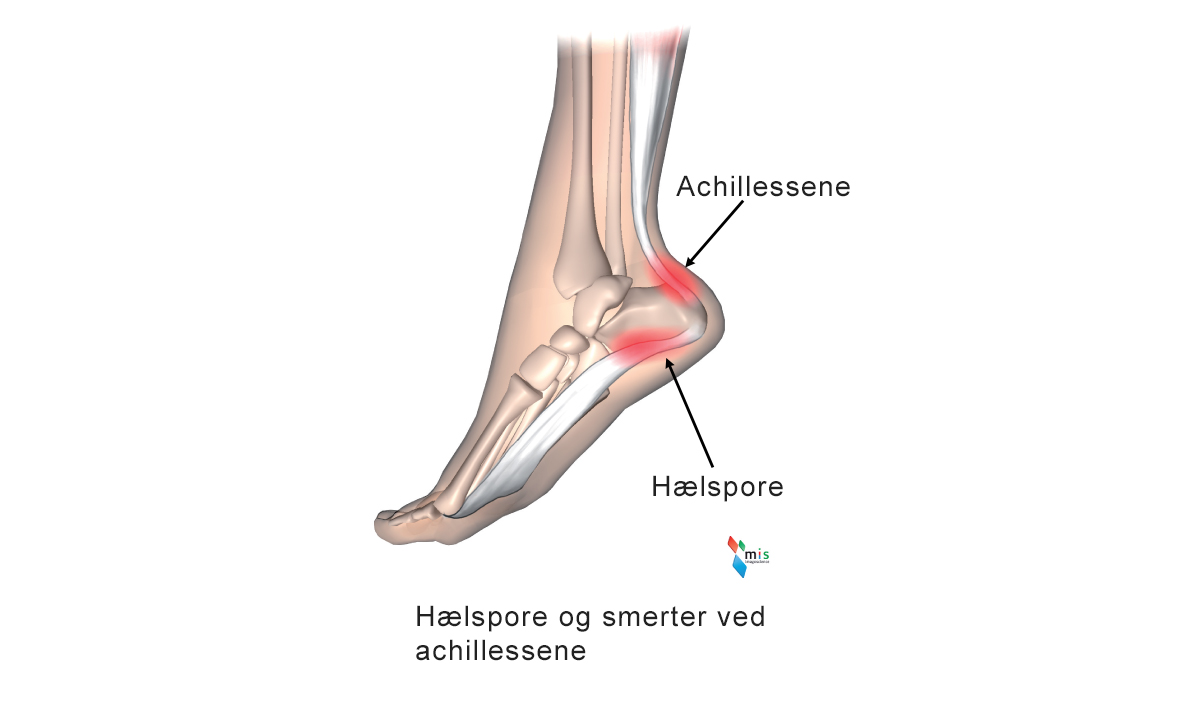 Illustration af hælspore og smerter ved achillessene.