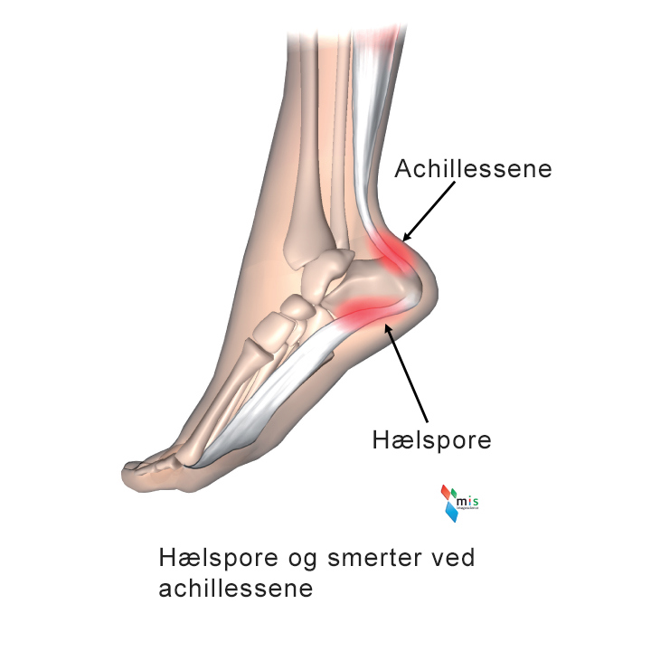 Illustration af hælspore og smerter ved achillessene.