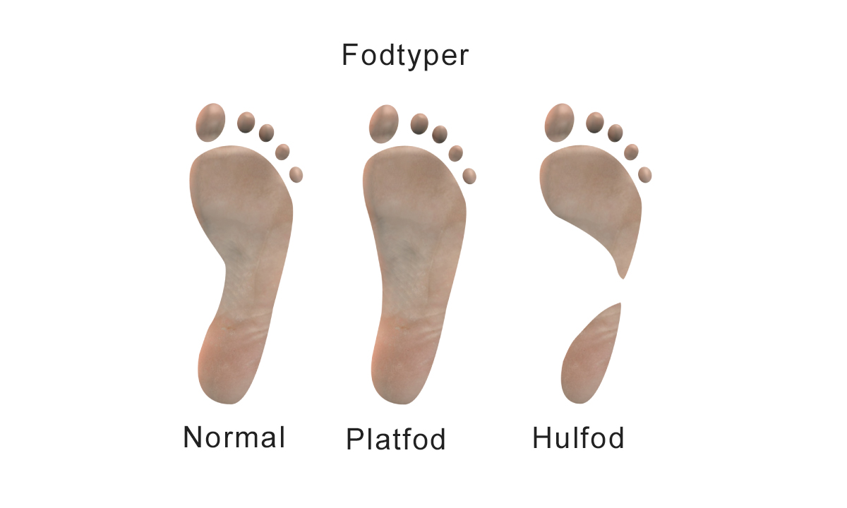 Illustration af normal fod, platfod og hulfod.