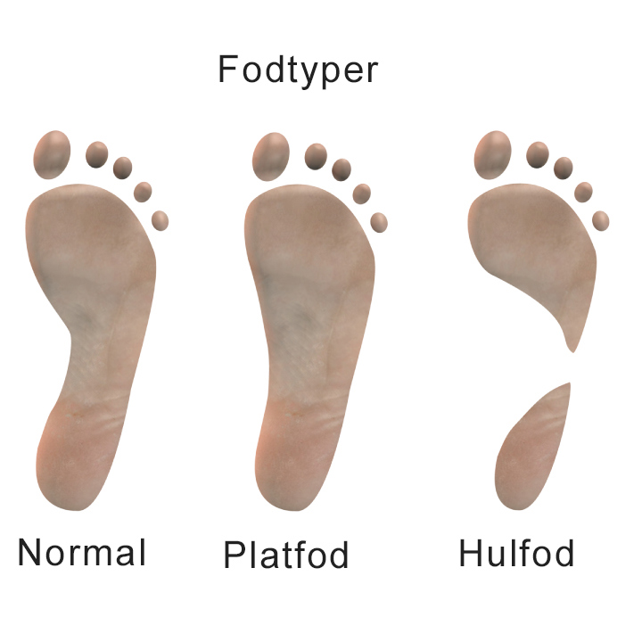 Illustration af normal fod, platfod og hulfod.