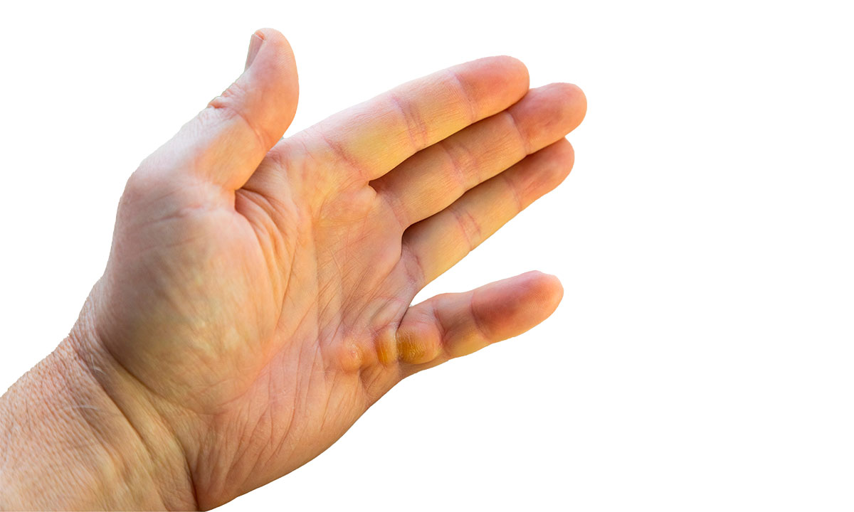 Billedet viser en hånd med kuskefinger.