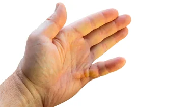 Billedet viser en hånd med kuskefinger.