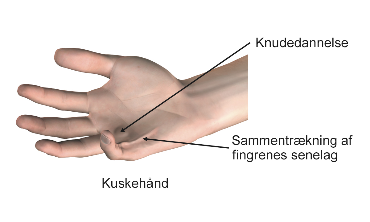 Kuskehånd med sammentrækning af fingrenes senelag.