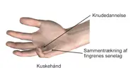 Kuskehånd med sammentrækning af fingrenes senelag.