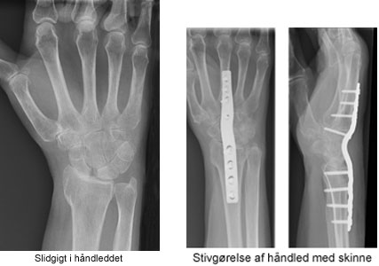 Røntgen af slidgigt i håndleddet og stivgørelse af håndled med skinne.