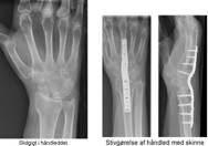 Røntgen af slidgigt i håndleddet og stivgørelse af håndled med skinne.