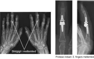 Røntgenbilleder af slidgigt i fingrene og et røntgen af en protese indsat i tredje fingers mellemled.